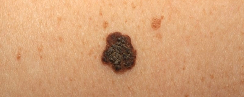 Problemi Con Macchie Cutanee? Ecco Quali Sono le Cause e i Rimedi.