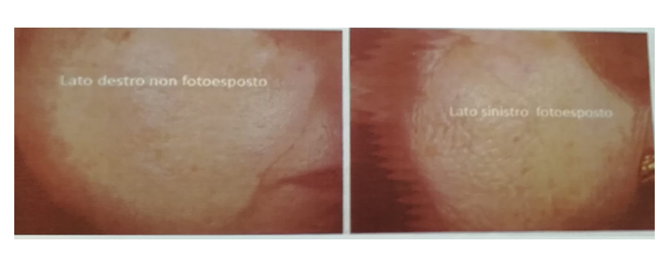 L'invecchiamento Cutaneo: Tipologie e Rimedi