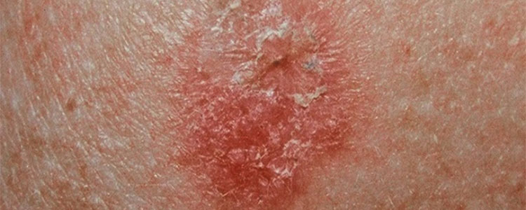 Problemi Con Macchie Cutanee? Ecco Quali Sono le Cause e i Rimedi.