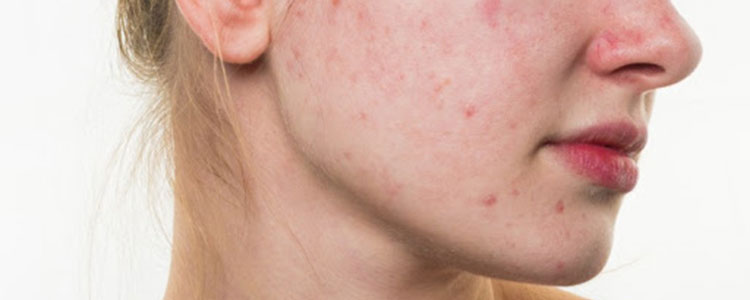 Problemi Con Macchie Cutanee? Ecco Quali Sono le Cause e i Rimedi.