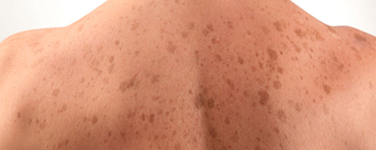 Problemi Con Macchie Cutanee? Ecco Quali Sono le Cause e i Rimedi.