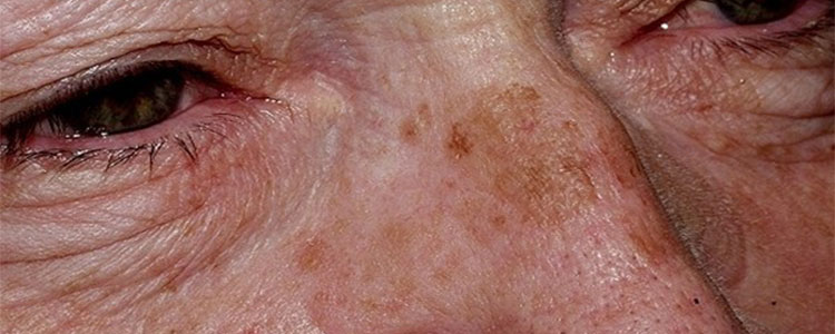 Problemi Con Macchie Cutanee? Ecco Quali Sono le Cause e i Rimedi.