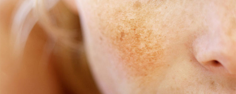 Problemi Con Macchie Cutanee? Ecco Quali Sono le Cause e i Rimedi.